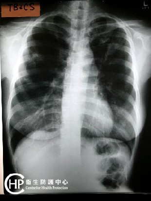 衞生防護中心 相片集 相片集 結核病